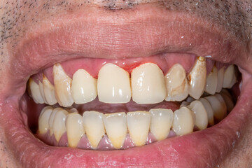 Dentistry patient with visible unaesthetic prosthodontic crowns in the incisors and bloody gingival...