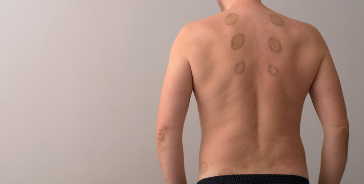hematomas on a man&rsquo;s back after a healing massage with medical glass jars