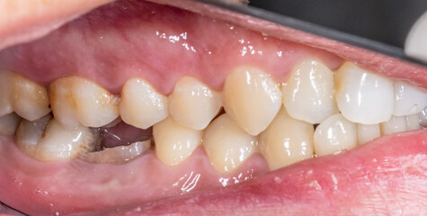 Lateral view of dental arches in occlusion with a lower molar decayed and destroyed crown. Macrophotography lateral mirror indirect view with cheek retractors, lips and gingival gum visible. 