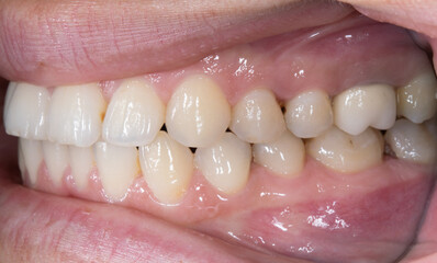 Lateral oblique view of dental arches open lips biting teeth occlusion with an upper molar restored...