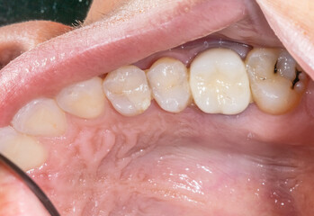 Part of the upper maxillary jaw with an aesthetic composite restoration on a premolar, an unaesthetic ceramic crown on a molar, and a decay on the last tooth. Close-up view of a dentistry patient case