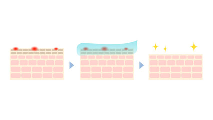 ケミカルピーリングの仕組みのイラスト