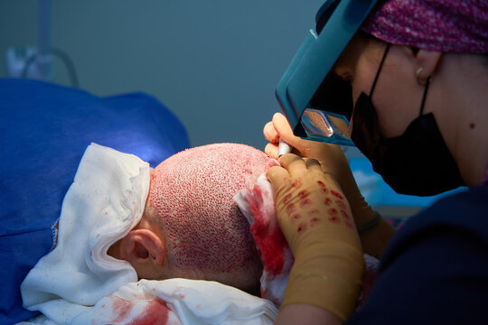 Surgeon performing hair transplant procedure on patient scalp