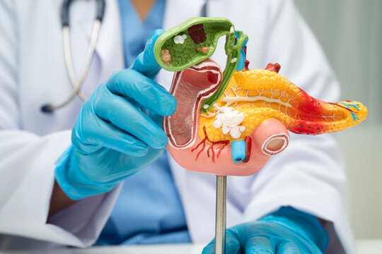 Pancreatitis, pancreatic cancer, Asian doctor with pancreas, gallbladder and bile duct human anatomy model at hospital.