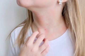 The child scratches atopic skin. Dermatitis, diathesis, allergy on the child's face.	