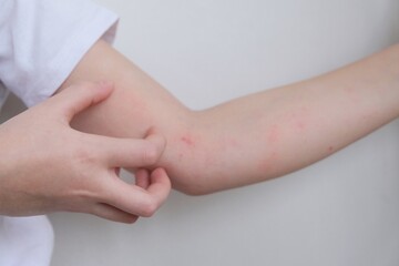 The child scratches atopic skin. Dermatitis, diathesis, allergy on the child's body.	