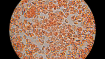Human blood under a microscope. You can see erythrocytes - red blood cells. The red color is given...