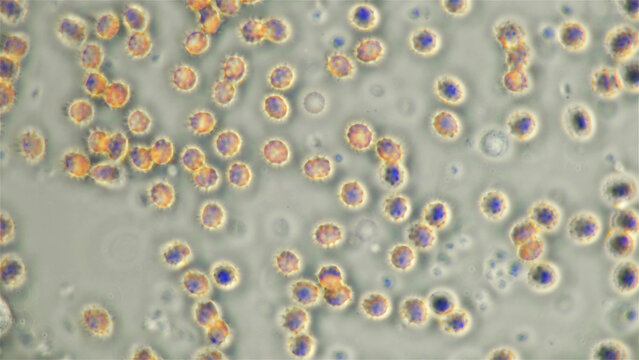 Blood human under a microscope, erythrocytes - echinocytes in the blood that changed shape and they appeared spikes (spicules), triangular outgrowths of the same size. Inverted colors