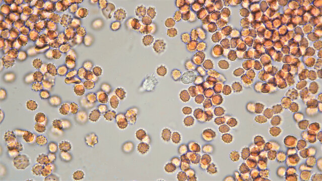 Blood human under a microscope, erythrocytes - echinocytes in the blood that changed shape and they appeared spikes (spicules), triangular outgrowths of the same size.