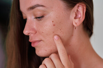 Young girl with oily problem sensitive facial skin suffering from acne, post-acne, cosmetology and dermatology