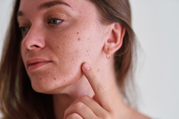 Young girl with oily problem sensitive facial skin suffering from acne, post-acne, cosmetology and...