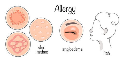 Allergy
