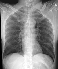 Chest X-ray for Evaluation of Lung Health and Pulmonary Conditions
