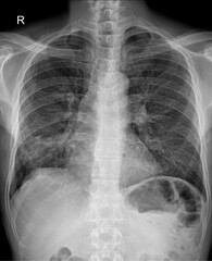 Chest PA Radiograph for Evaluation of Lung Disease and Pulmonary Pathologies