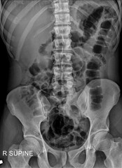 X-Ray Imaging of Bowel Blockage and Intestinal Obstruction