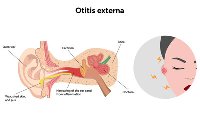Obraz premium Otitis externa anatomy ear disease inflammation 