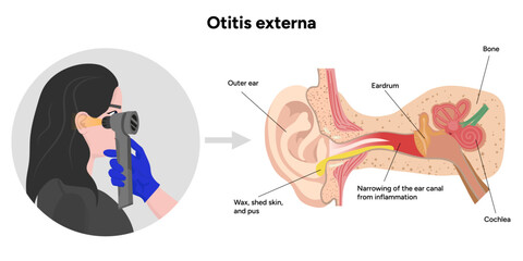 Otitis externa anatomy ear disease inflammation 