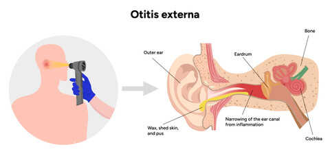 Otitis externa anatomy ear disease inflammation and check up in doctor appointment 