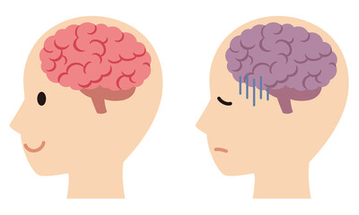 元気な脳とストレスを受けた脳　脳のイメージ　健康