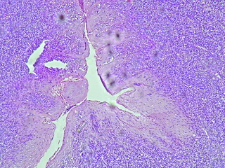 Anatomy and Histology of Bilateral Tonsils and Parotid Human Cells with chronic tonsillitis results...
