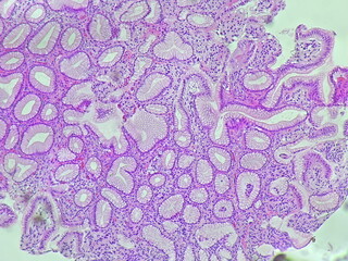 Human cell tissue under microscope in pathology laboratory. Microscopic picture of chronic gastric...