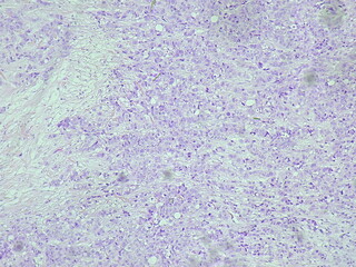 Human breast tissue under a microscope in a pathology laboratory. Microscopic view of invasive...