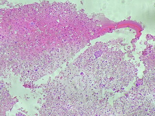 invasive carcinoma of the left lung. Malignant cells. Histological tissue under a microscope