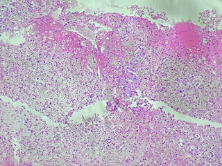 invasive carcinoma of the left lung. Malignant cells. Histological tissue under a microscope