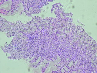 Human cell tissue under microscope in pathology laboratory. Microscopic picture of chronic gastric...