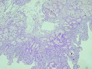 Human cell tissue under microscope in pathology laboratory. Microscopic picture of chronic gastric...