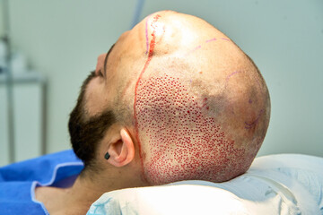 Close-up of patient's scalp after hair transplant procedure showing grafts