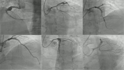 Coronary angiogram showing left and right coronary arteries multiple views.