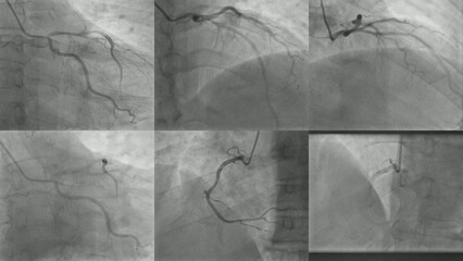 Coronary angiography , left and right coronary angiography