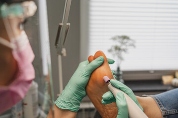 Podiatric foot treatment - milling of the epidermis with a tool. A close-up of the treatment. Close...