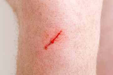 Young adult man red abrasion knee skin bleeding after fell down. Closeup. Front view.