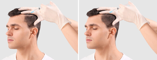 Young man before and after hair loss treatment on light background