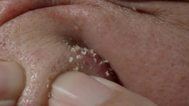 Squeezing pimples on the nose with hands. Pushing and squeezing to release the clogged acne sebum. Close up skin pore clogged acne sebum. Many clogged acne released on the nose. Skin problem concept.