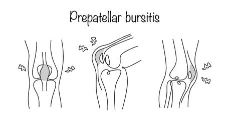 Prepatellar bursitis