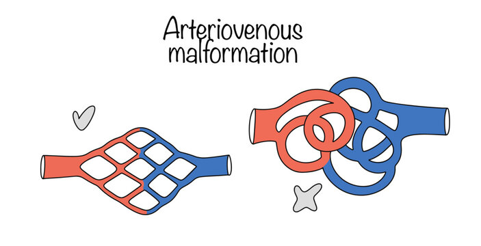 Arteriovenous malformation