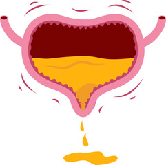 Bladder disease illustration. Urinary tract infection. Bladder cancer. Bladder stones. Bladder inconvenience.