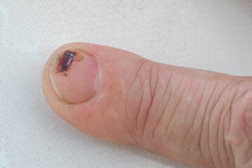 A man's finger with a hematoma on the nail after a blow
