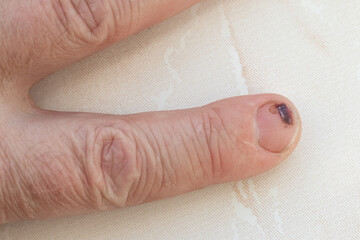 man's hand with a hematoma on his nail after a blow