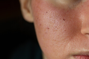 Close-up of skin after laser resurfacing – CO2 fractionated laser.