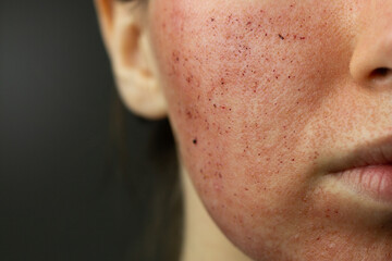 Close-up of skin after laser resurfacing – CO2 fractionated laser.