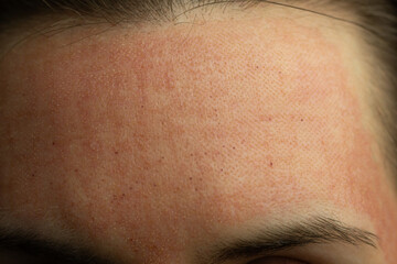 Close-up of skin after laser resurfacing – CO2 fractionated laser.