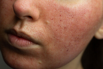 Close-up of skin after laser resurfacing – CO2 fractionated laser.