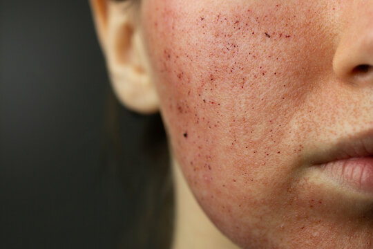 Close-up of skin after laser resurfacing &ndash; CO2 fractionated laser.