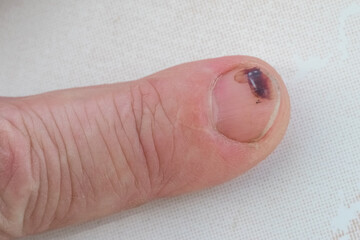 A man's finger with a hematoma on the nail after a blow