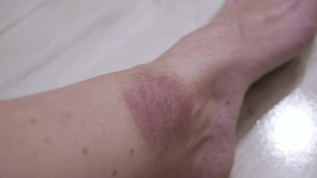 Close up, Formation of a Large Red Spot on the Skin from a Tick Bite. Irritation, itching, swelling, infection, redness around skin of leg. Lyme disease. Insect, mosquito, encephalitis tick bite.