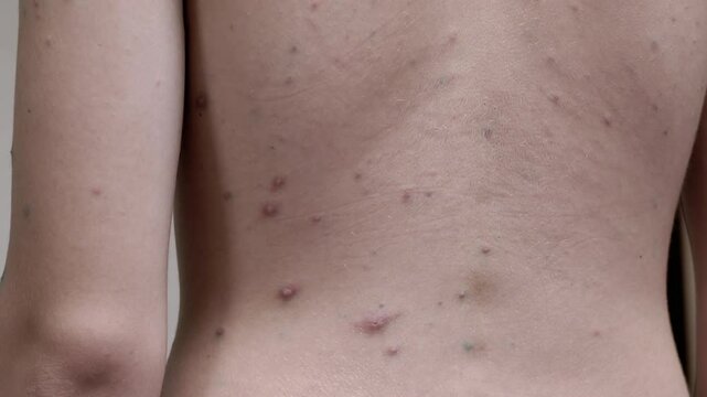 A teenager's back is shown with numerous pimples and acne, highlighting common skin issues during puberty.
